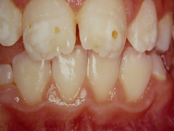 Fluoroprofilassi, Perchè è Importante? - ORAL TEAM Centro Odontoiatrico